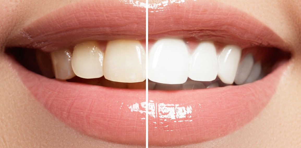 Blanchiment des dents : esthétique du sourire | Dr Temstet | Paris 17