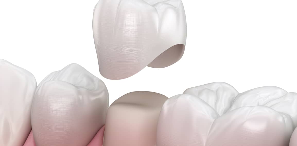 Couronnes : prothèses dentaires | Soins Prothétiques | Dr Temstet | Paris 17