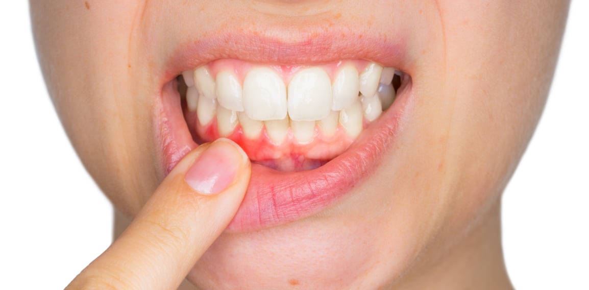Gingivite : causes et traitements dentaires | Dr Temstet | Paris 17
