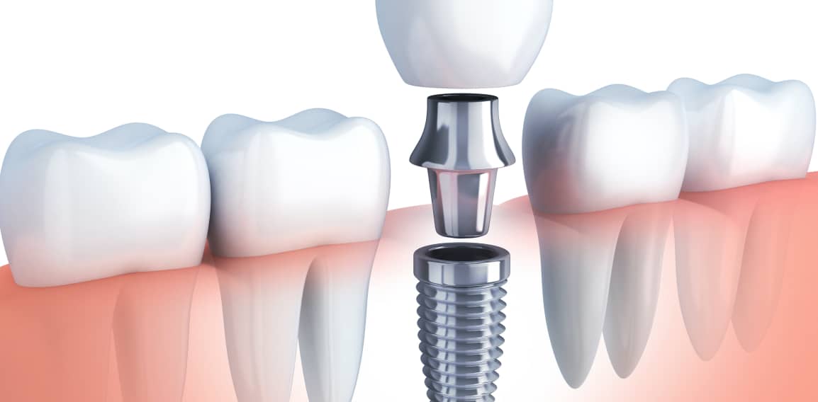 Implant dentaire : la pose et les tarifs | Dr Temstet | Paris 17