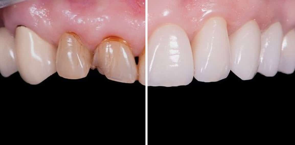 Dent cassée : causes et traitements dentaires | Dr Temstet | Paris 17