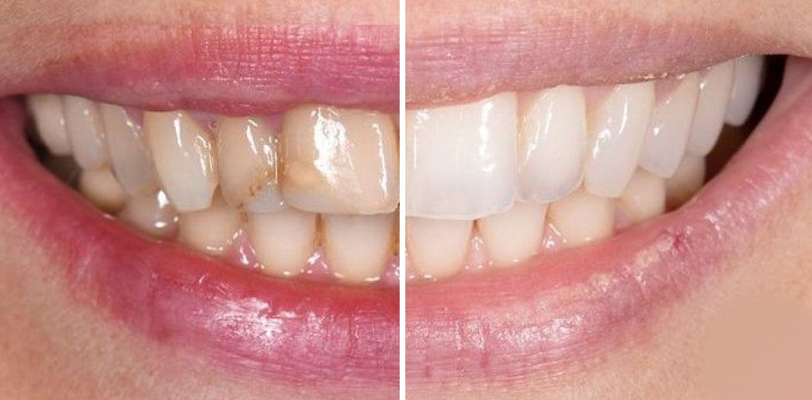 Dents jaunes : causes et traitements dentaires | Dr Temstet | Paris 17