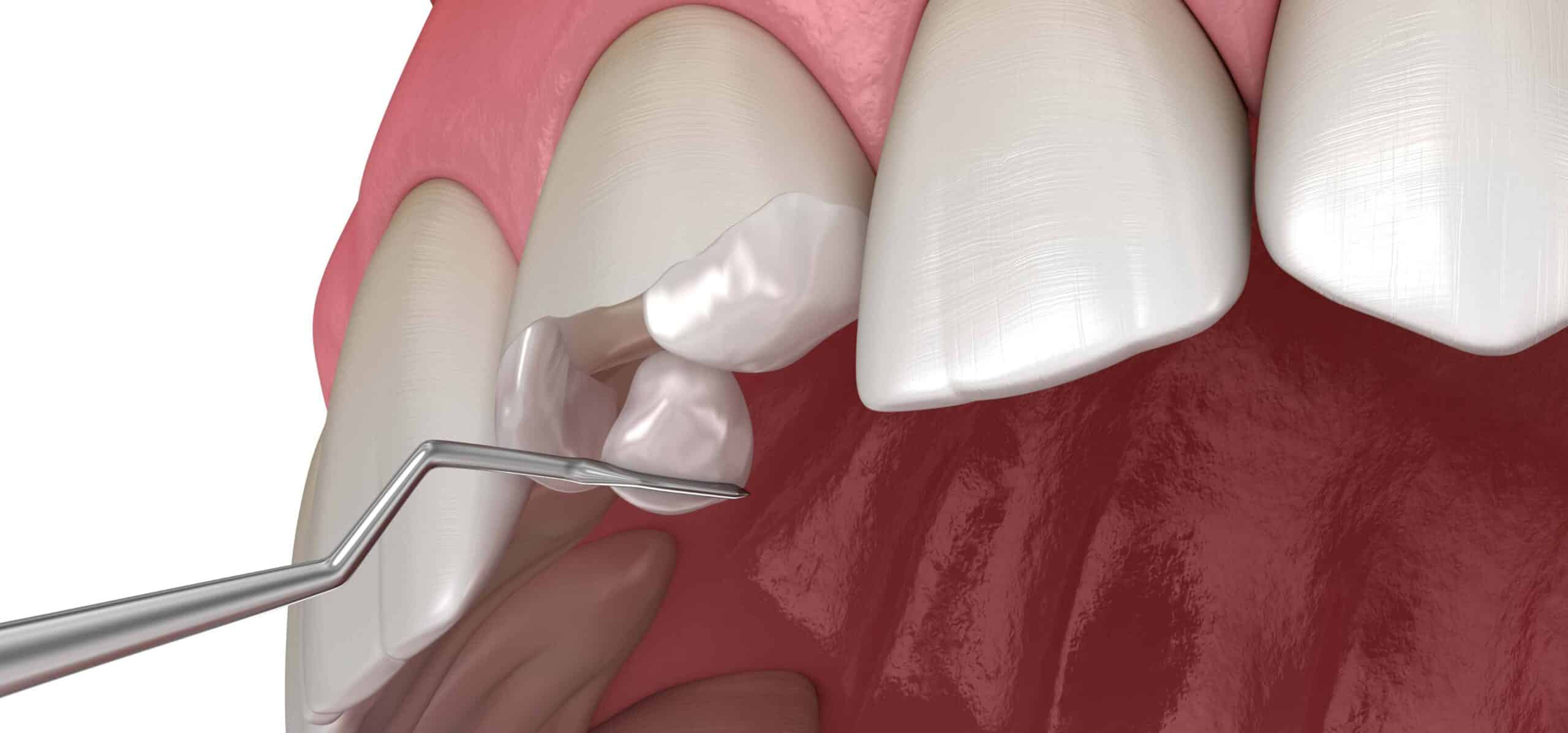 Peut-on réparer une dent cassée ? | Dr Temstet | Paris