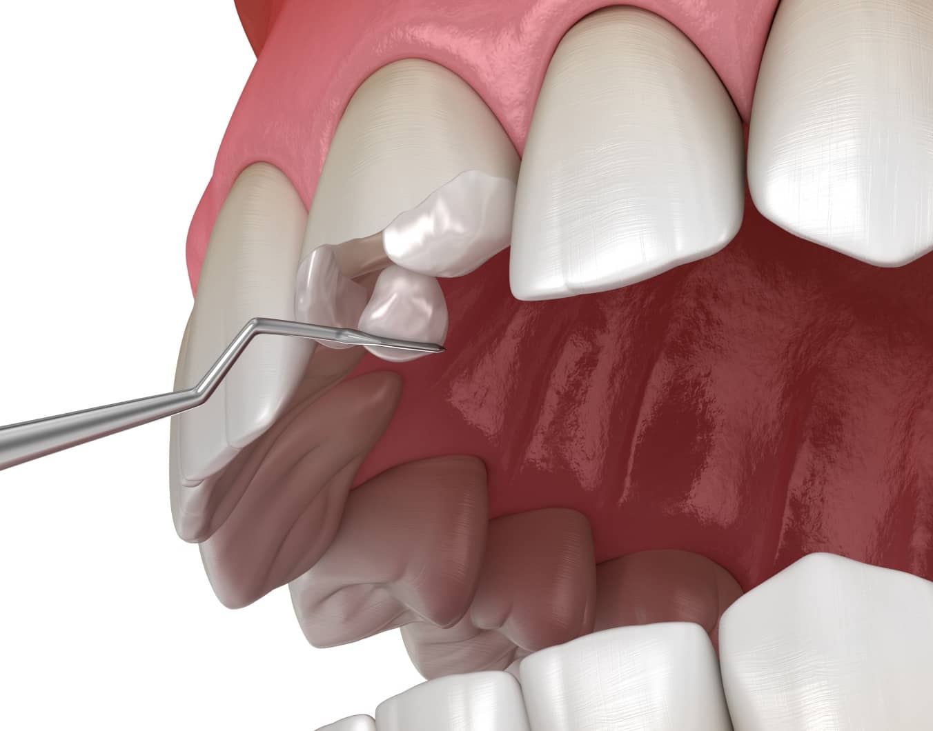 Peut-on réparer une dent cassée ? | Dr Temstet | Paris