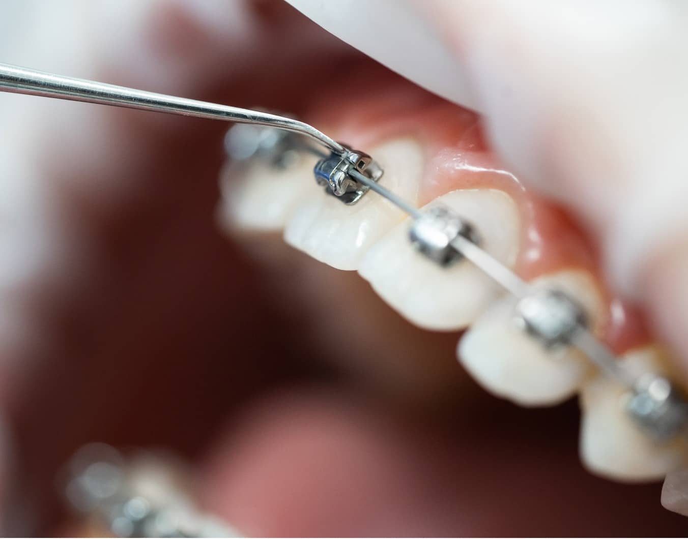 Les bénéfices d’un traitement orthodontique sur la santé bucco-dentaire | Dr Temstet | Paris