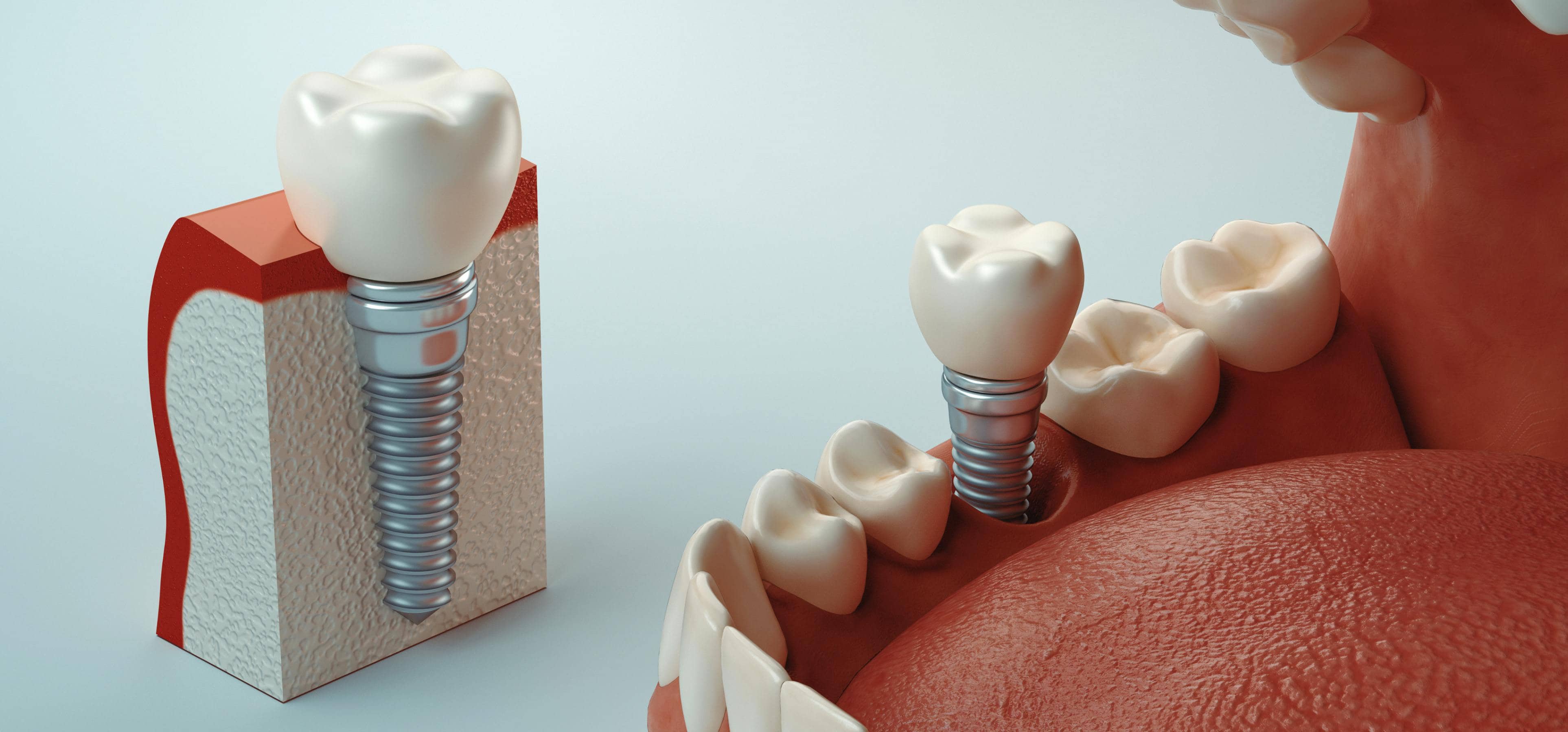Implants dentaires : combien de temps après une greffe osseuse ? | Dr Temstet | Paris