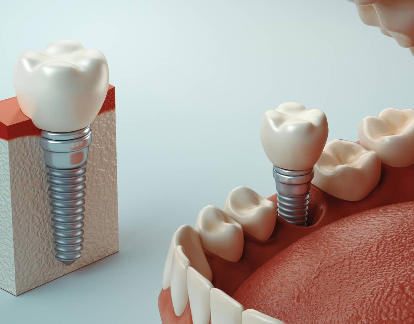 Implants dentaires : combien de temps après une greffe osseuse ? | Dr Temstet | Paris