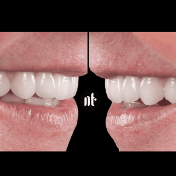 Facettes dentaires et traitement parodontie | Dr Temstet | Paris