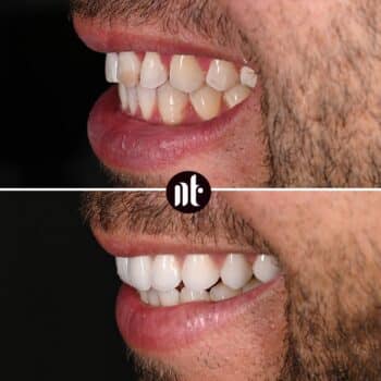 Traitement orthodontique associé à la mise en place de facettes