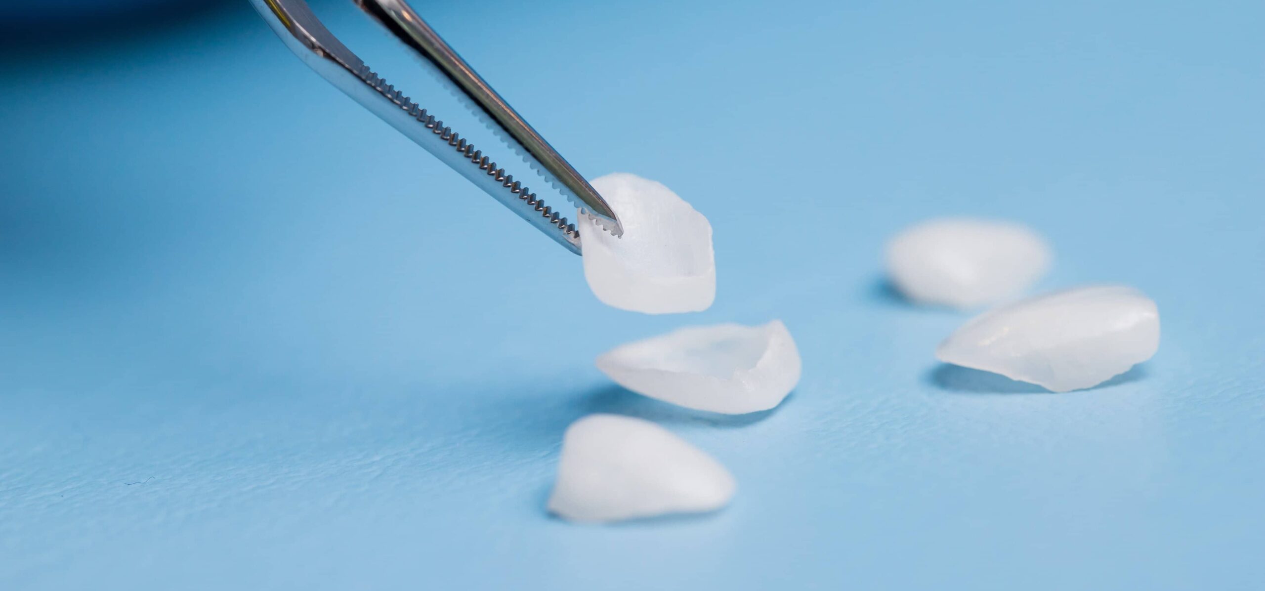 Faut-il mieux choisir des facettes dentaires en céramique ou en composite ? | Dr Temstet | Paris