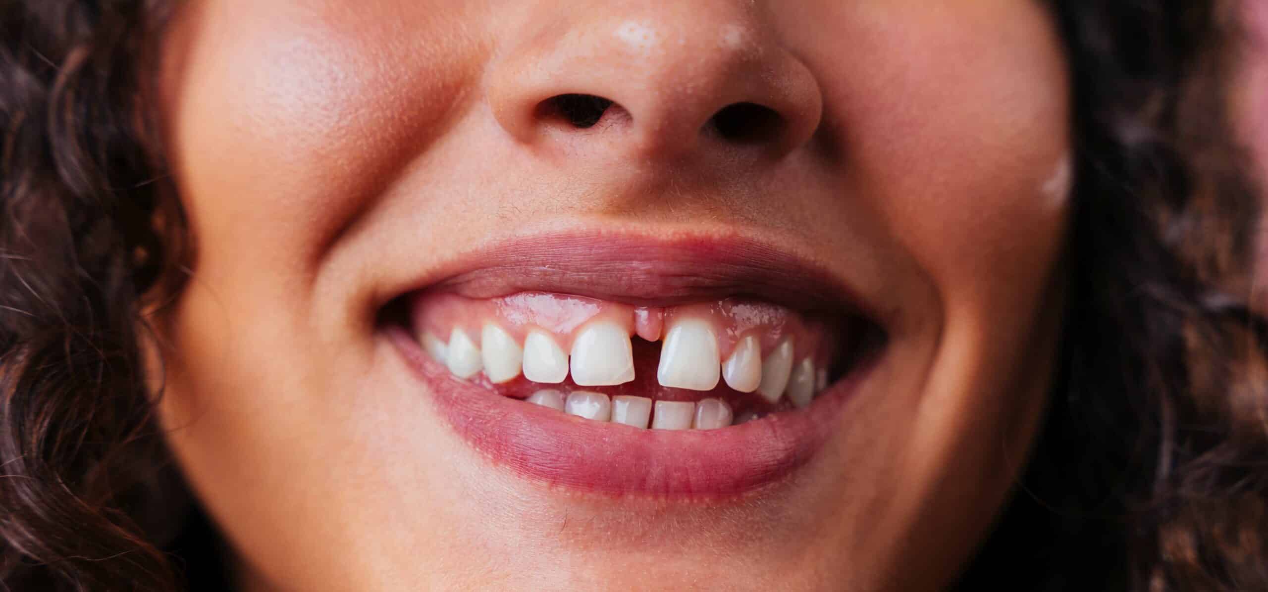 Les facettes dentaires : une solution pour corriger les dents du bonheur | Dr Temstet | Paris
