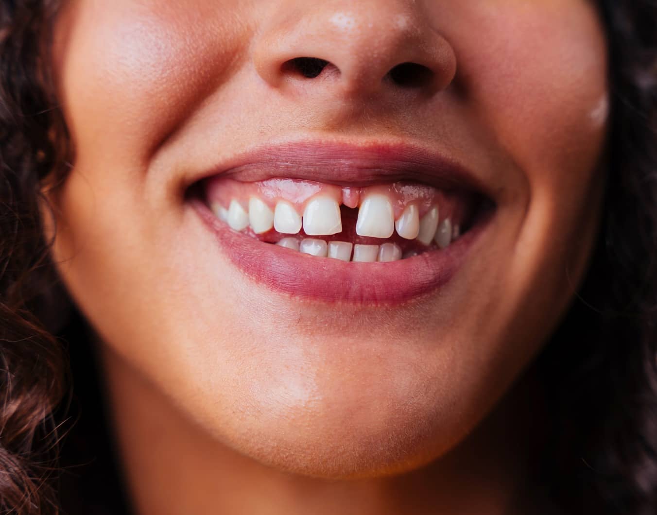 Les facettes dentaires : une solution pour corriger les dents du bonheur | Dr Temstet | Paris