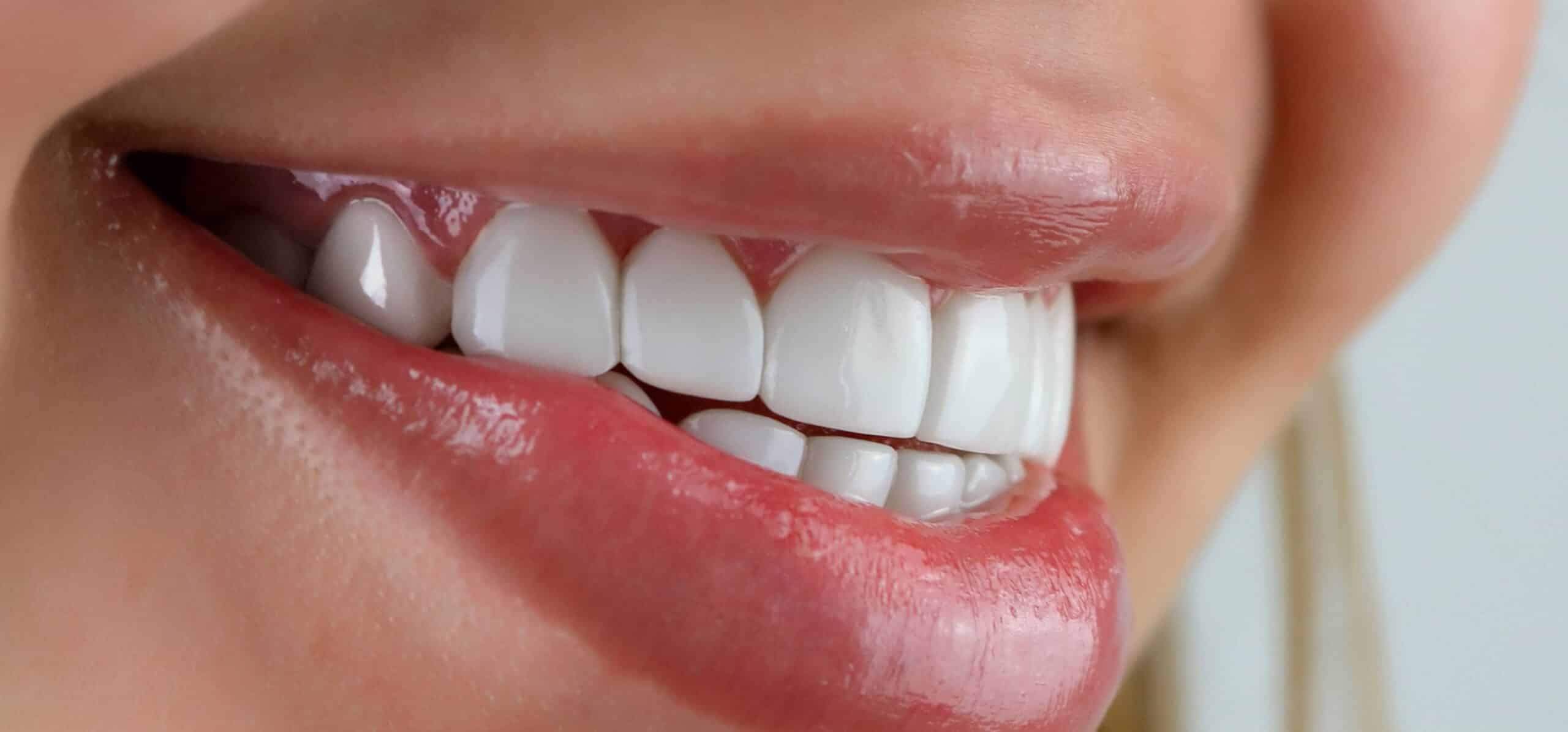 Les facettes dentaires nécessitent-elles un renouvellement ? Dr Temstet | Paris
