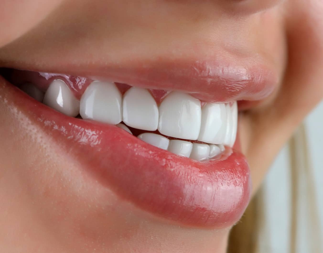 Les facettes dentaires nécessitent-elles un renouvellement ? Dr Temstet | Paris